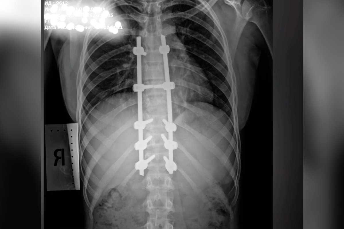 У девочки был компрессионный перелом трех грудных позвонков У девочки был компрессионный перелом трех грудных позвонков