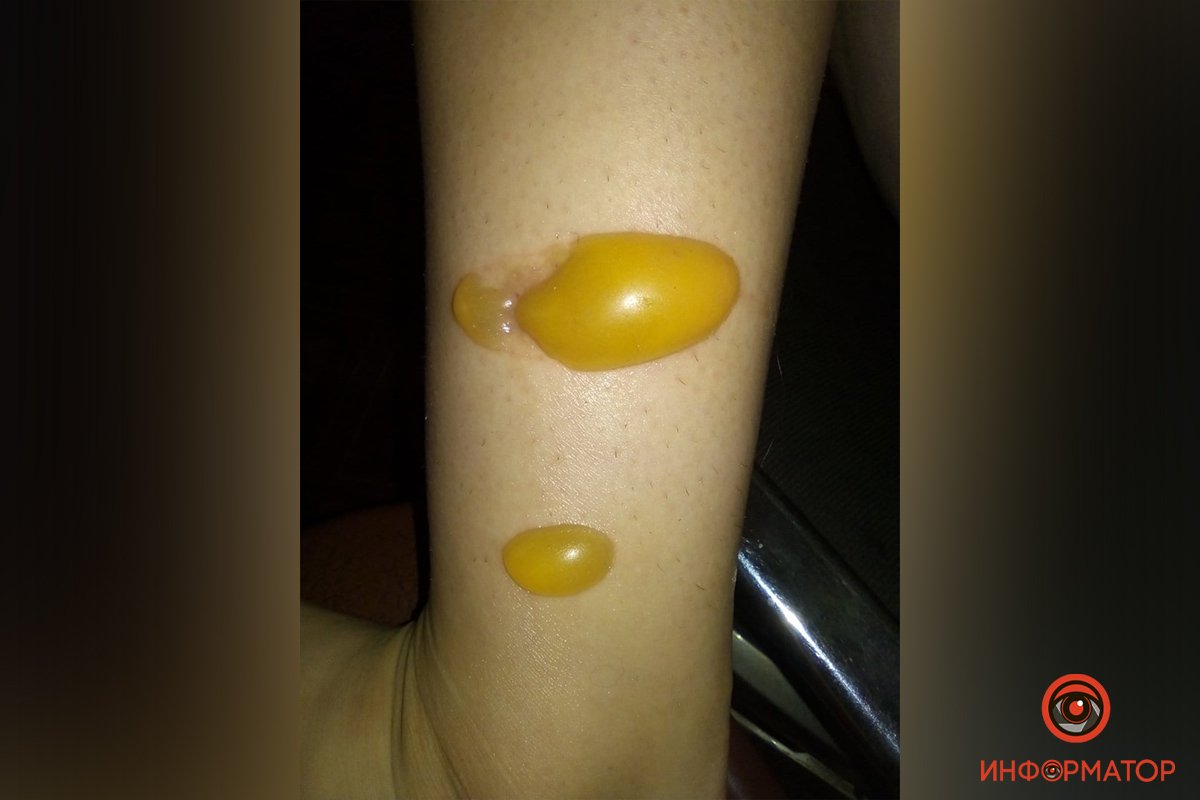 нога ребенка с ожогом нога ребенка с ожогом