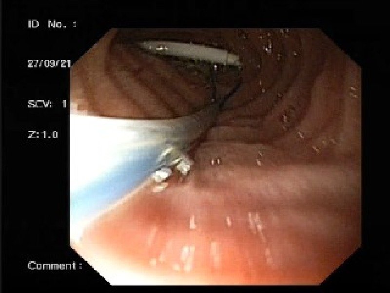 Попала в кишечник