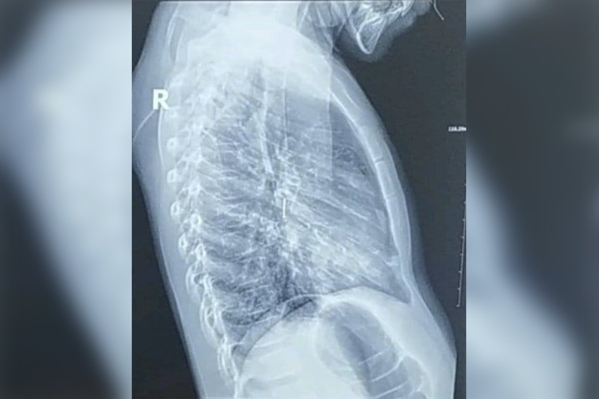 Ребенку провели ригидную бронхоскопию