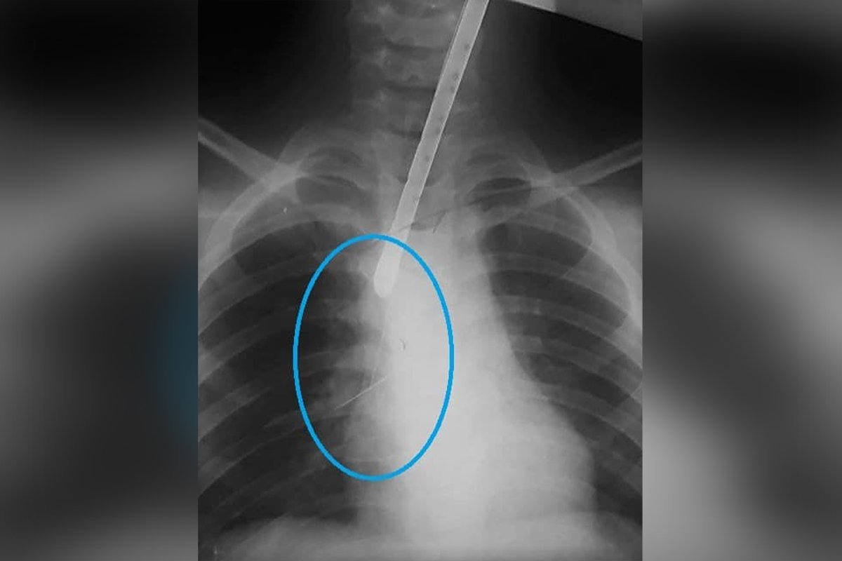 Рентген грудной клетки ребенка