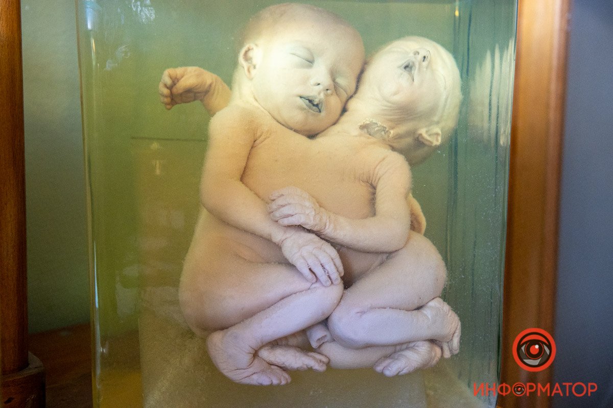 Сиамские близнецы Сиамские близнецы