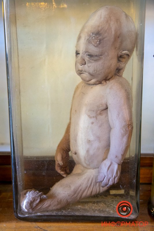 Сиреномелия - так называемый "синдром русалки" Сиреномелия - так называемый "синдром русалки"