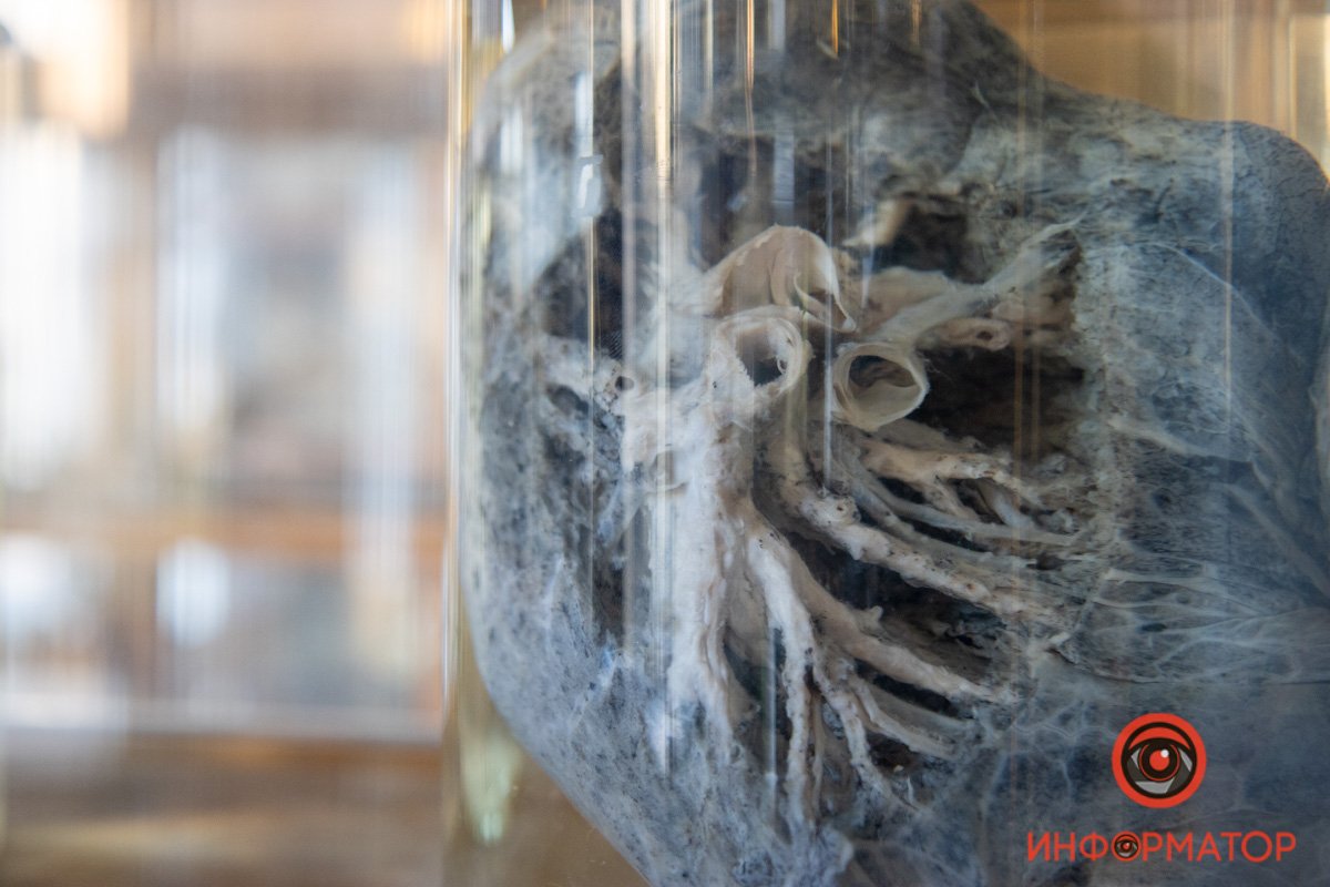 Легкие курильщика Легкие курильщика