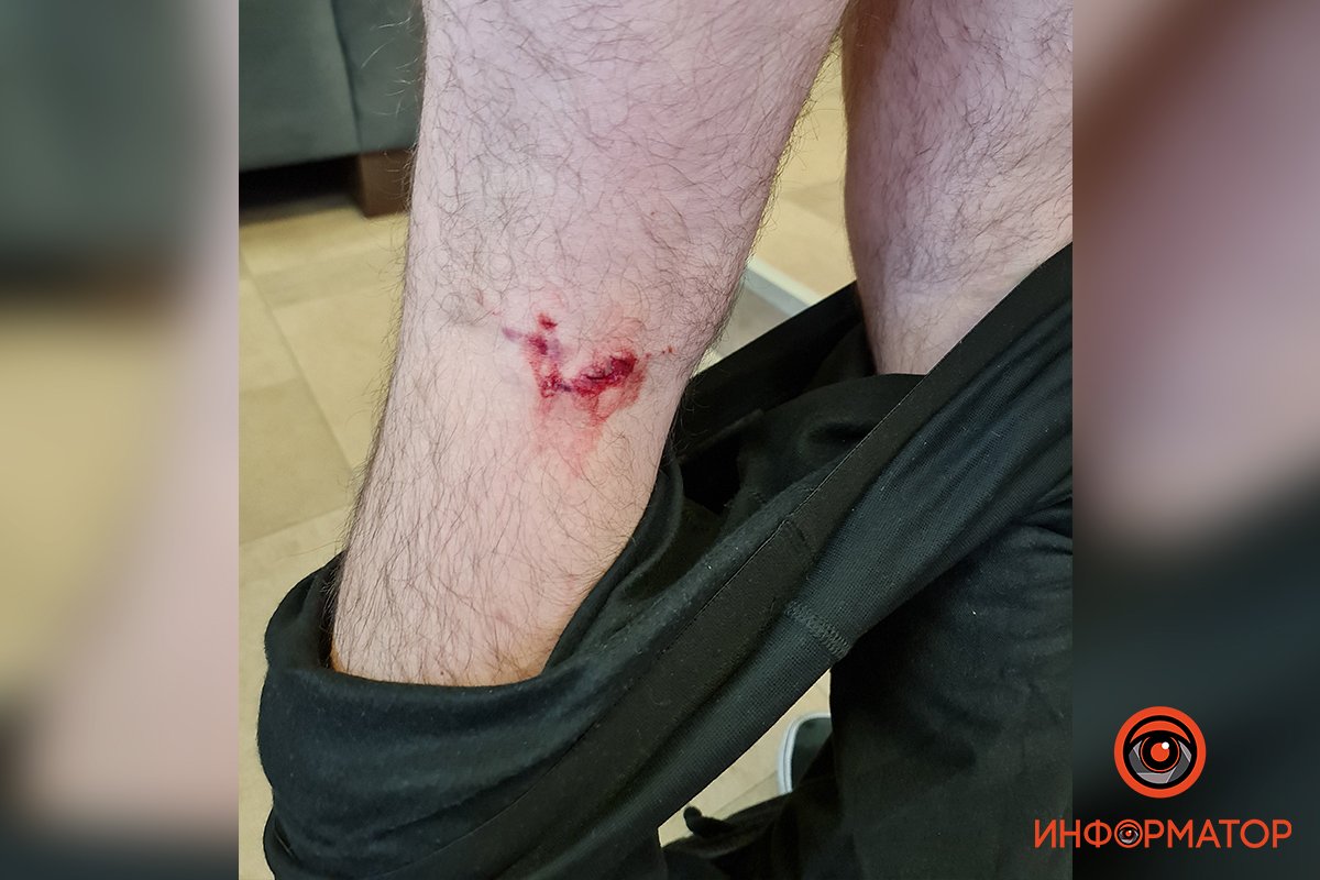 Укусили за ногу Укусили за ногу