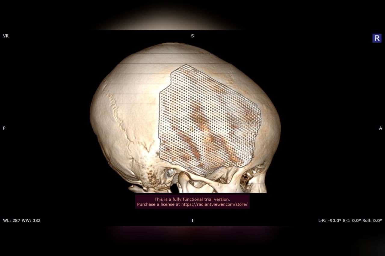 3Д-модель черепа с пластиной