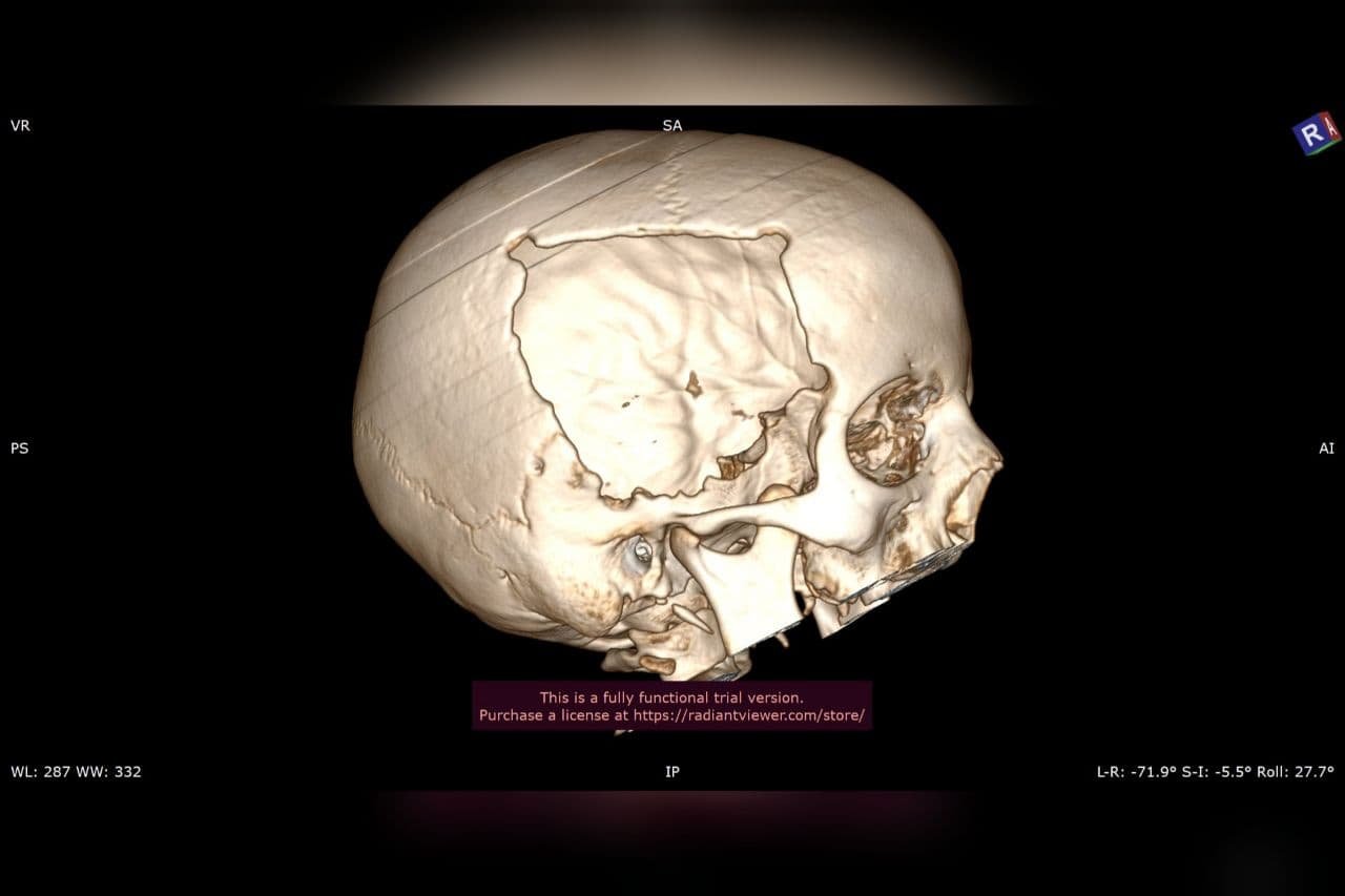 Визуализация повреждений черепа