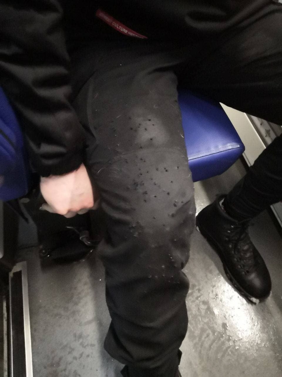 Следы от выстрелов на ноге у жертвы нападения