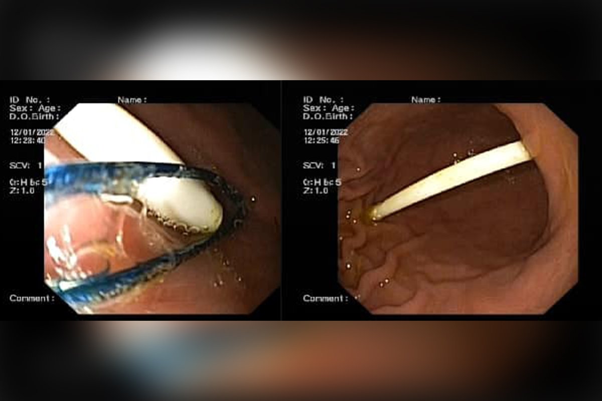 Палочку от Chupa Chups удалили эндоскопически