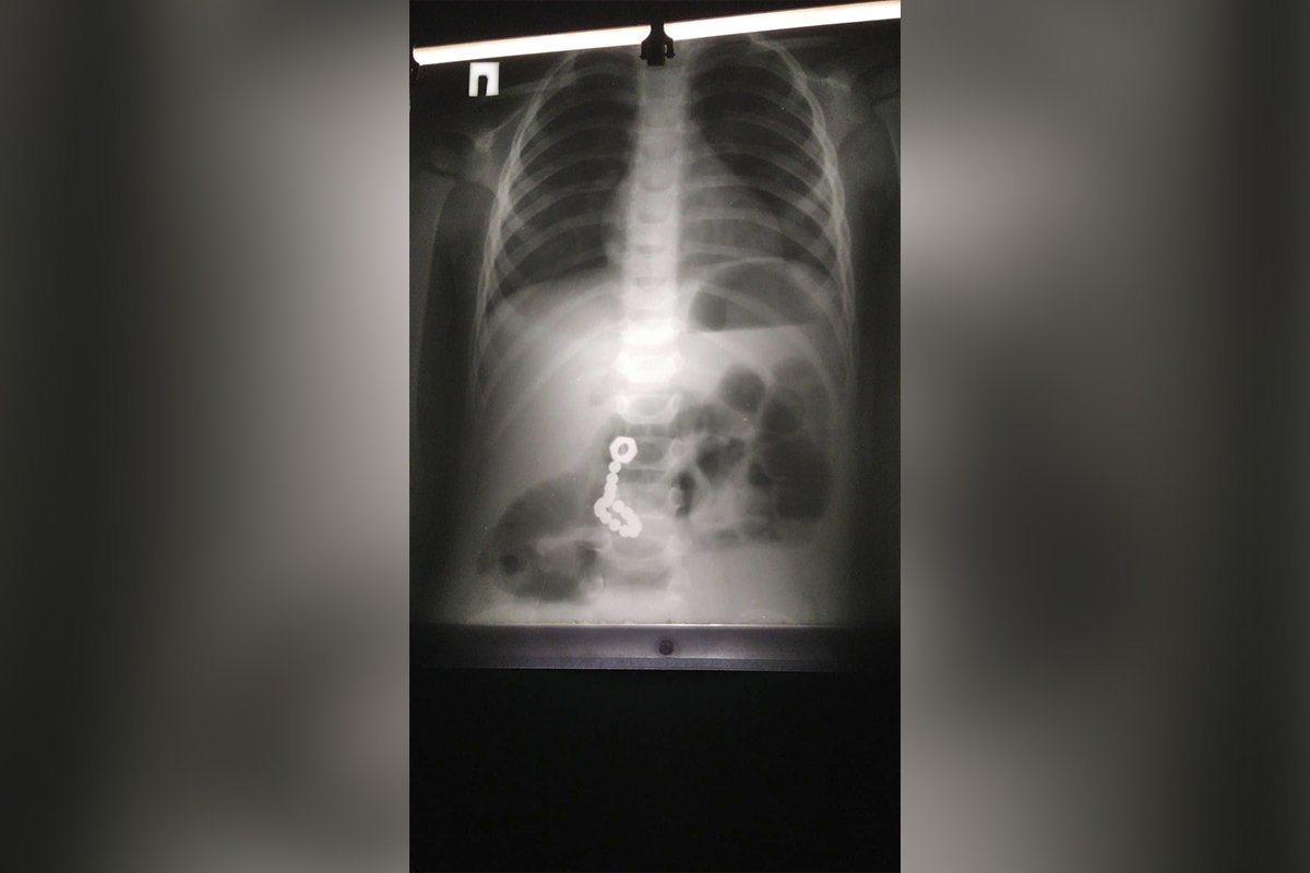 2-летний мальчик проглотил детали магнитного конструктора 2-летний мальчик проглотил детали магнитного конструктора