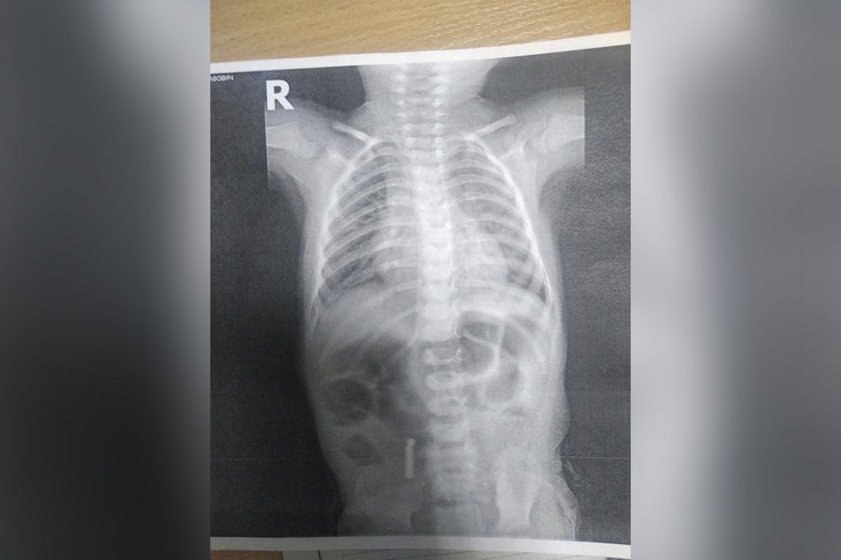 Мальчика прооперировали в больнице Мальчика прооперировали в больнице