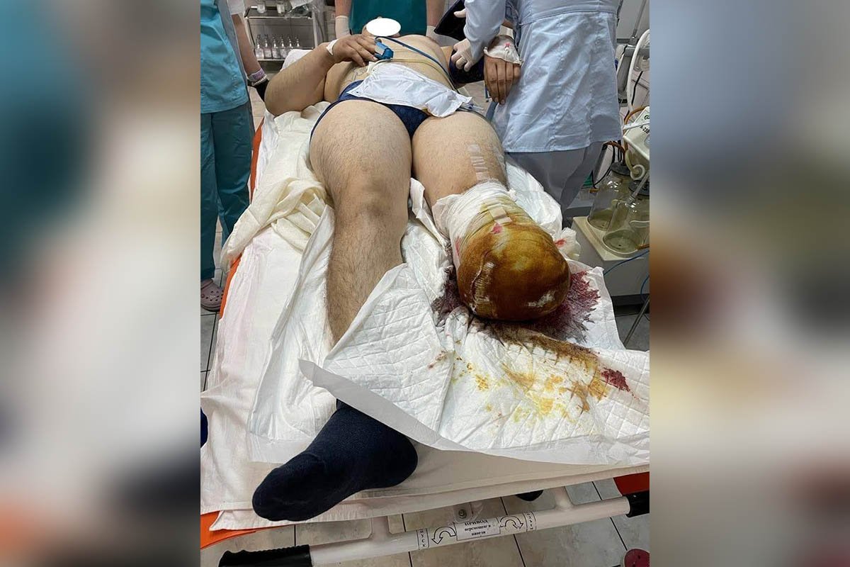 В Днепре в больнице Мечникова спасают Защитника Украины, которому оторвало ногу 1