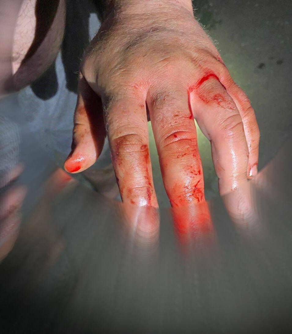 В Днепре на Навигационной мужчина откусил часть пальца своему другу 1