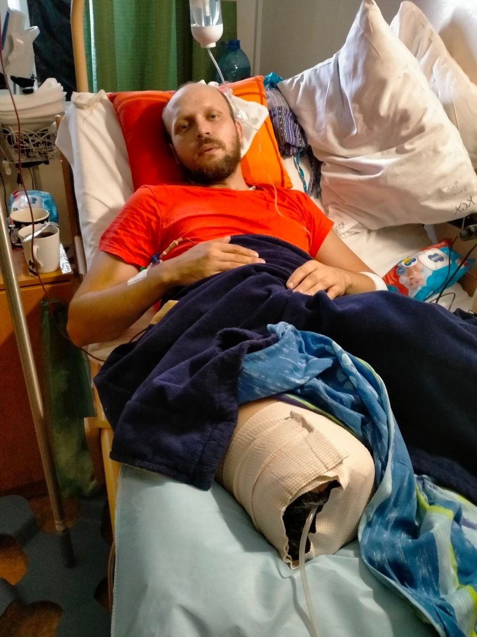 Ногу ампутували