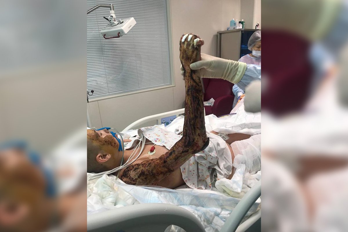 Дівчинка отримала важкі опіки щонайменше 25% тіла