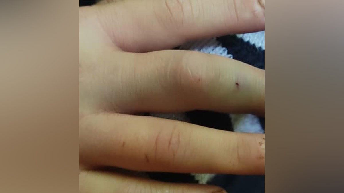 6-річного хлопчика вкусила змія 6-річного хлопчика вкусила змія