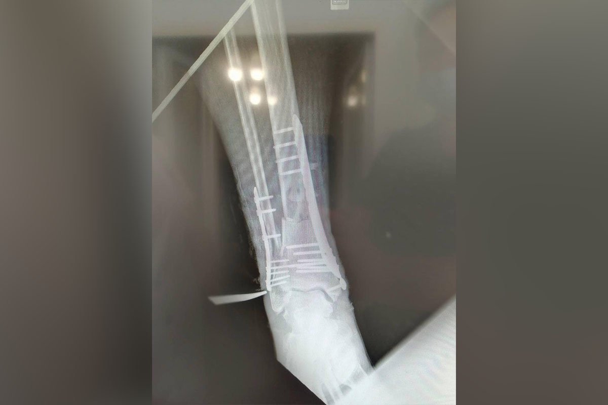 У ранах залишилися шматки деревини та одягу після вибуху