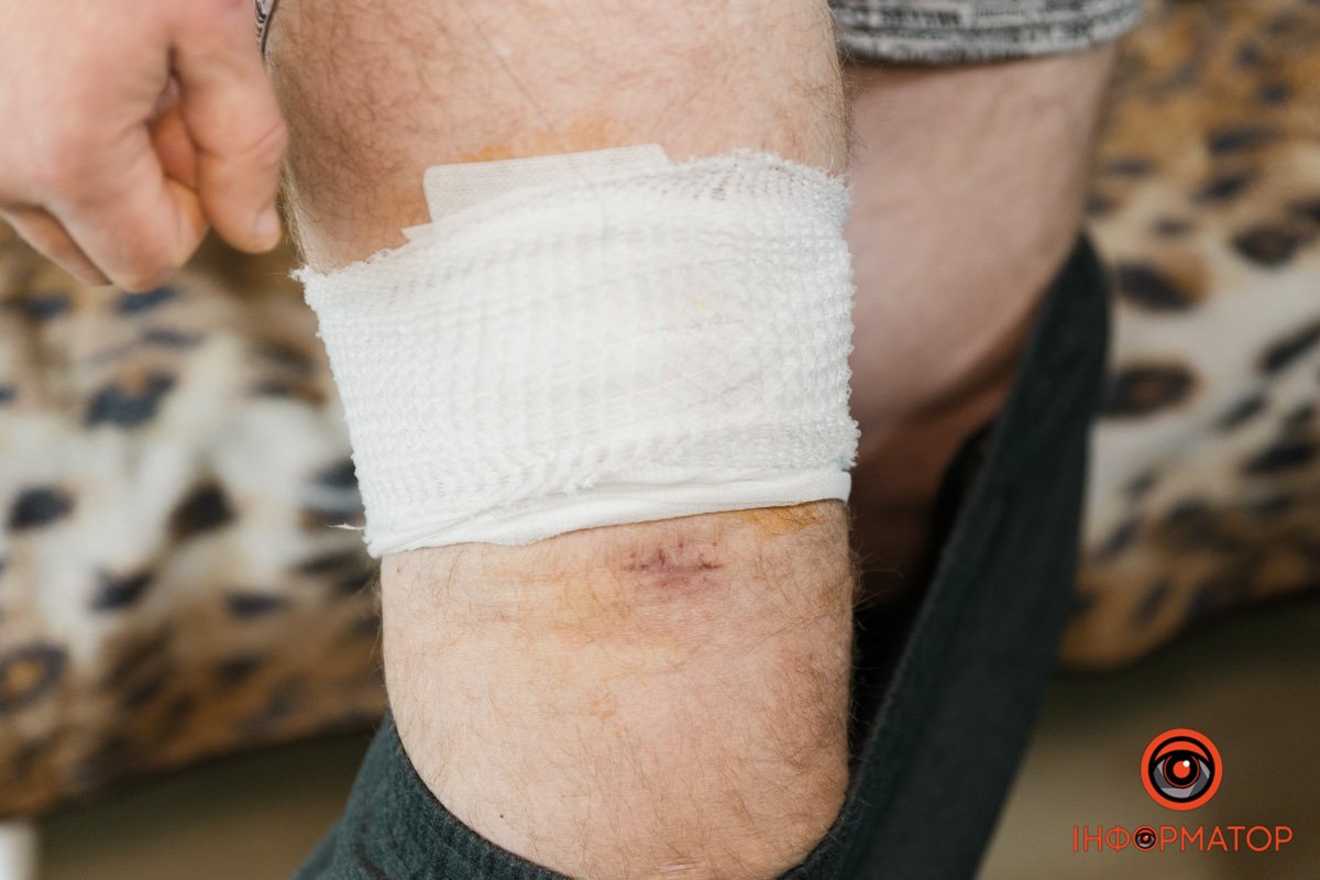 Осколок прилетів на кілька сантиметрів вище попередньої рани