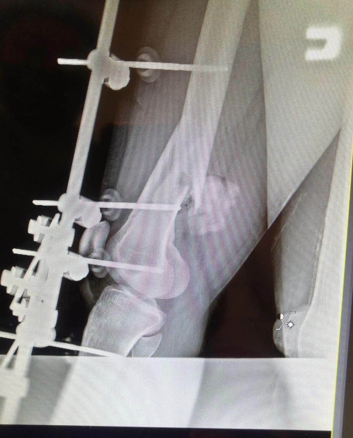 Врятували ногу