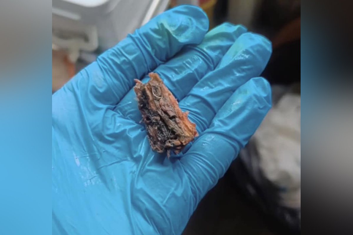 У зашитій рані хірурги знайшли ще один уламок, дерев‘яний