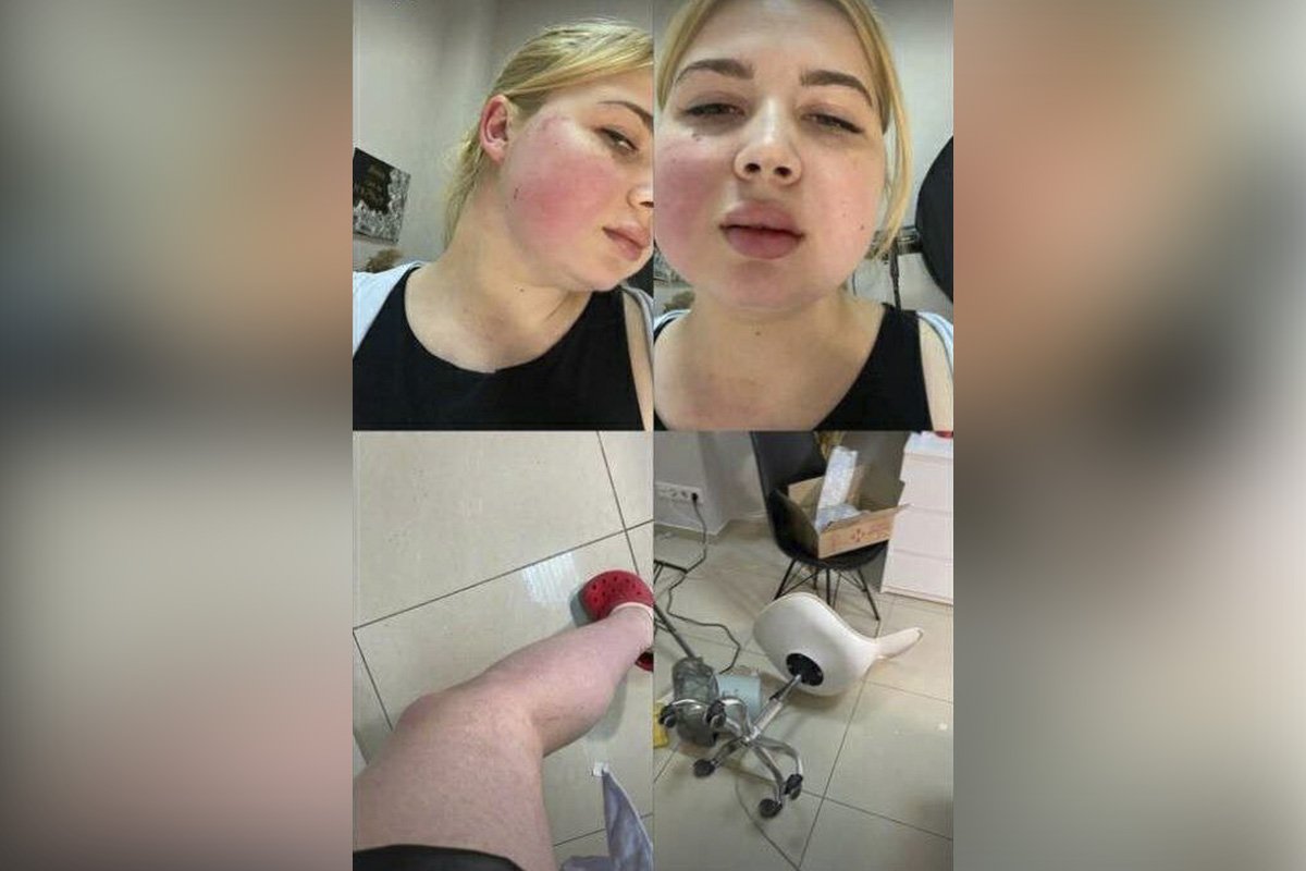 Жінка після побиття