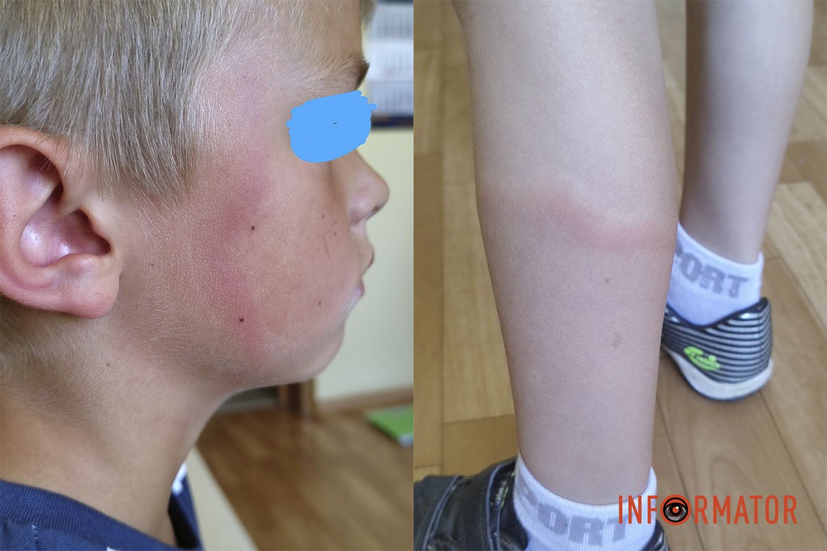 Последствия укусов клещей Последствия укусов клещей