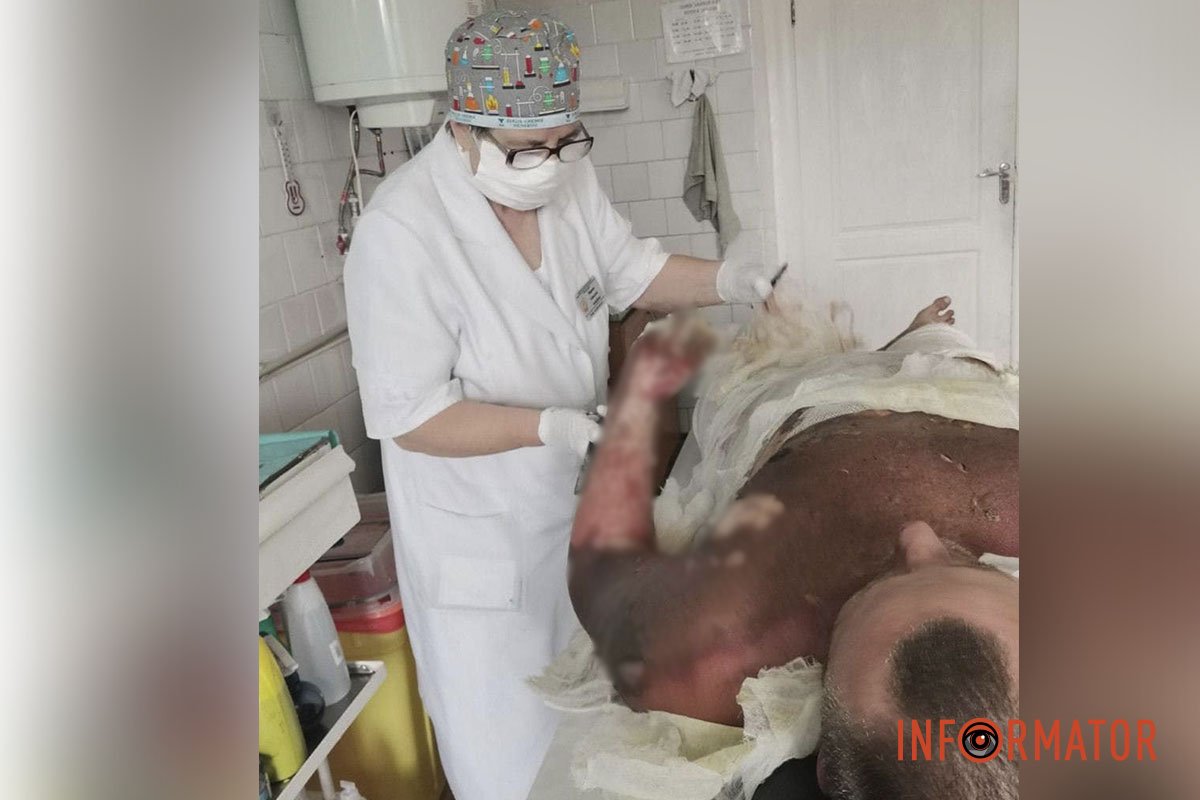 Опік полум’ям становив 90% поверхні тіла Опік полум’ям становив 90% поверхні тіла