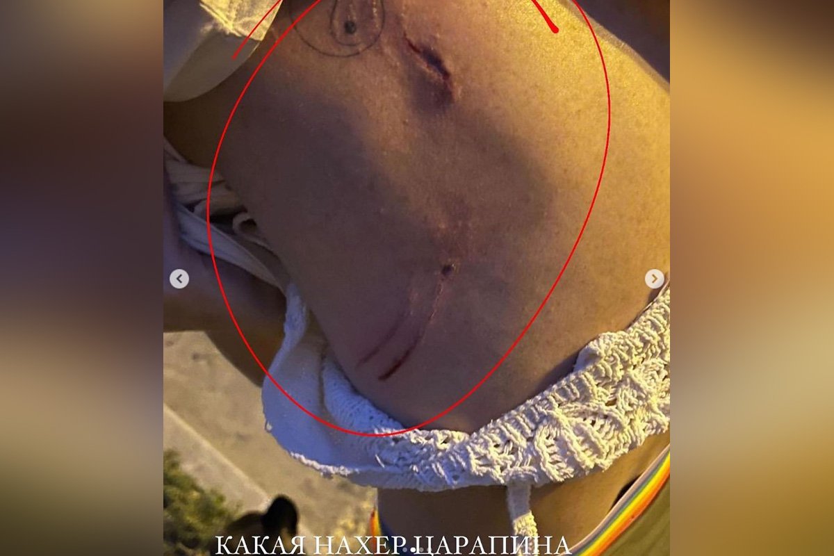 Рана постраждалої Рана постраждалої