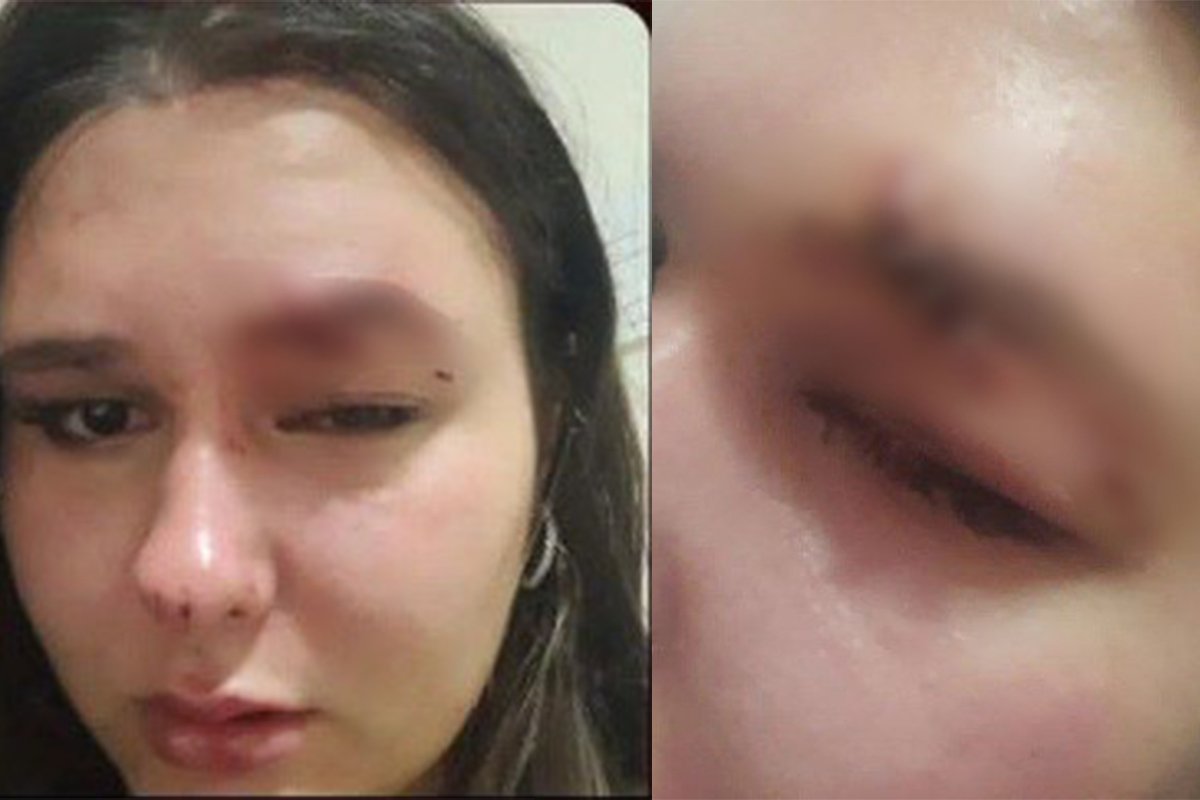 Потерпілій наклали чотири шви на око Потерпілій наклали чотири шви на око