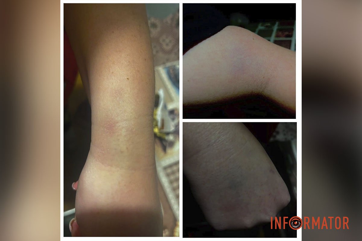 Синяки Синяки