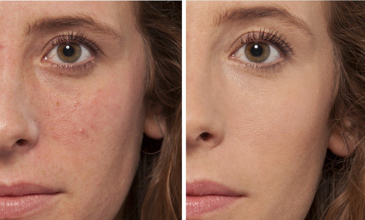 На картинке "до и после" показано действие консилера На картинке "до и после" показано действие консилера