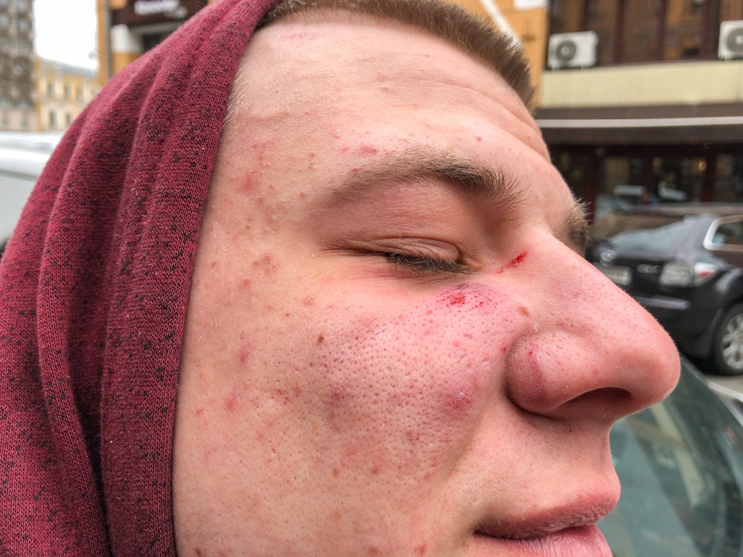 Пассажир получил рассечение возле глаза и синяк на скуле. Также была попытка удушения ремнем безопасности