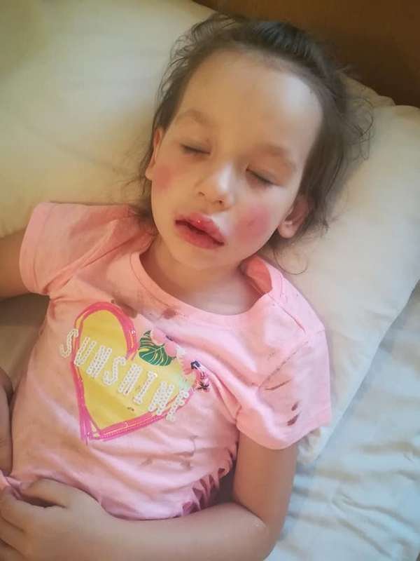 5-летняя девочке удалили два зуба и зашили челюсть 5-летняя девочке удалили два зуба и зашили челюсть