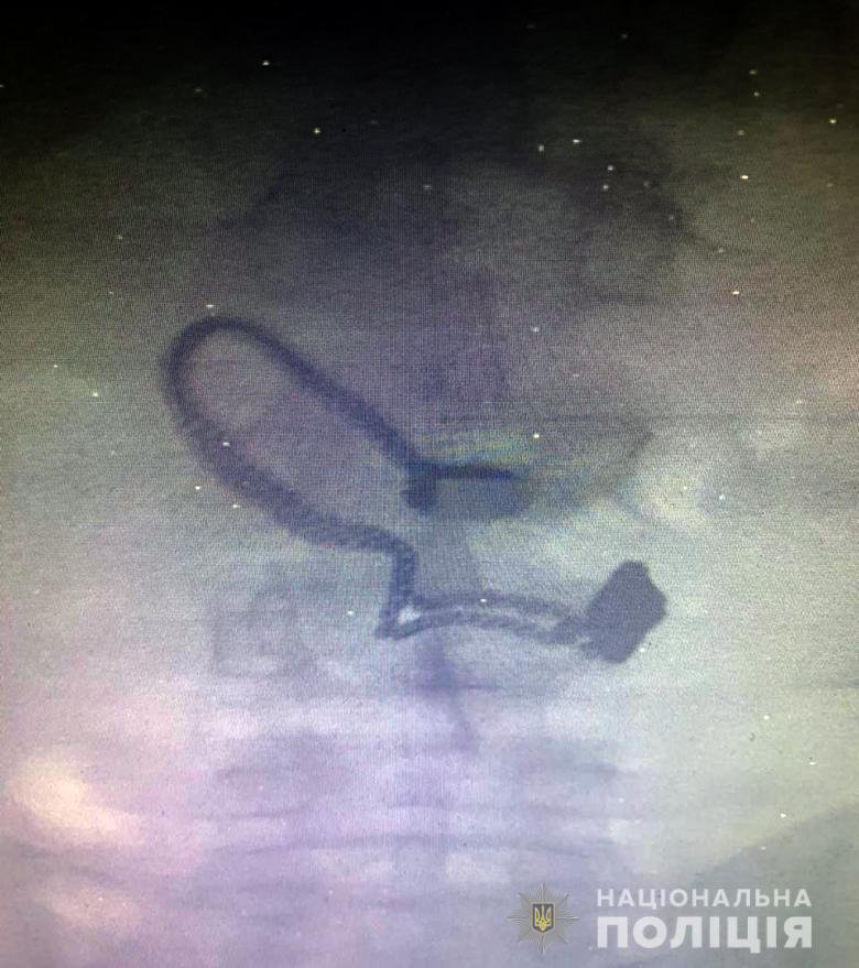 Во время медосмотра на рентген-снимке задержанного врачи увидели украденное украшение