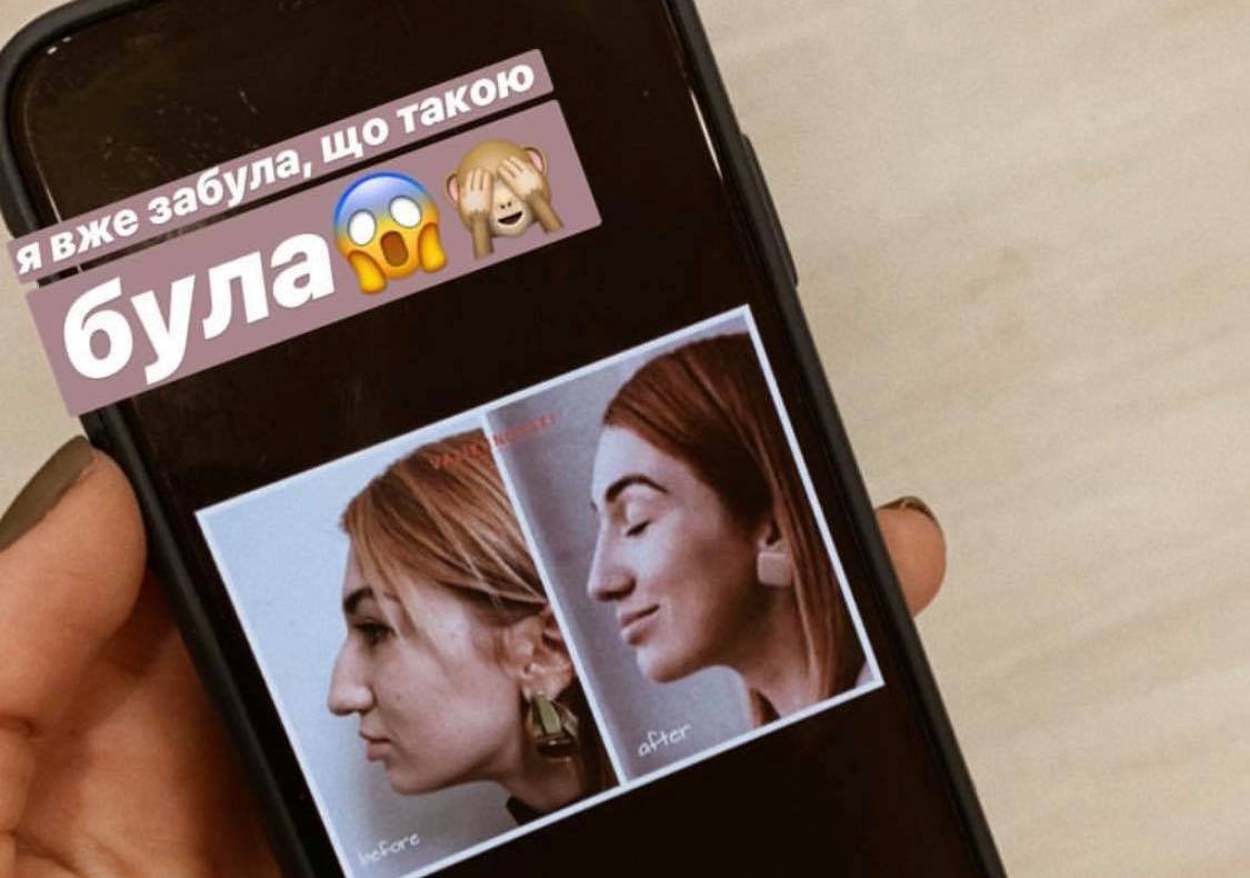 Скрин из истории на страничке Тани - до и после ринопластики.