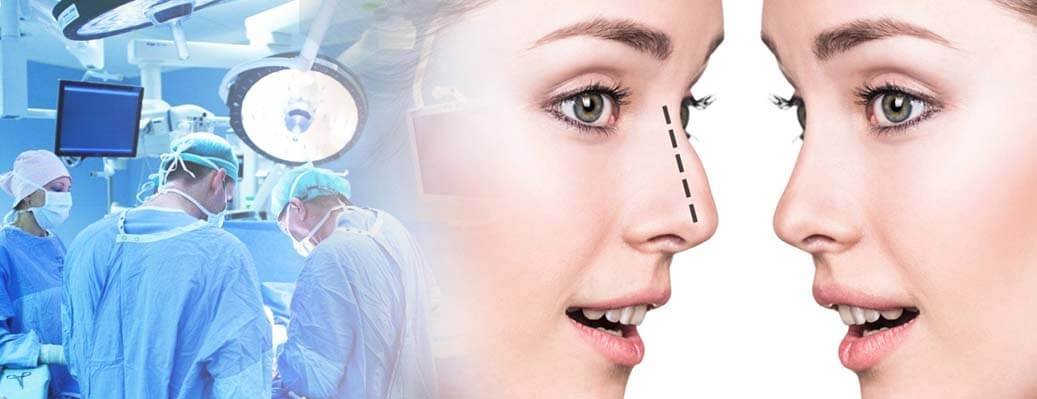 Где в Киеве сделать идеальный нос и почему не нужно бояться ринопластики 2