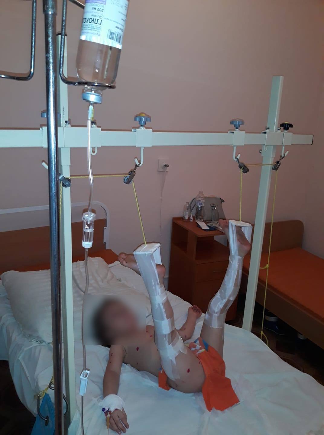 Четырехлетний ребенок сейчас находится в больнице с переломом Четырехлетний ребенок сейчас находится в больнице с переломом