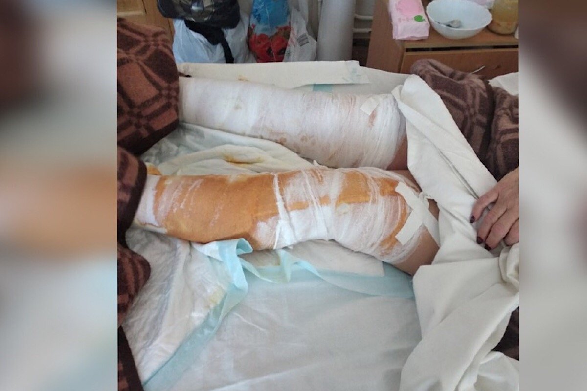 Пострадавшая от ожогов 59-летняя Надежда Пострадавшая от ожогов 59-летняя Надежда