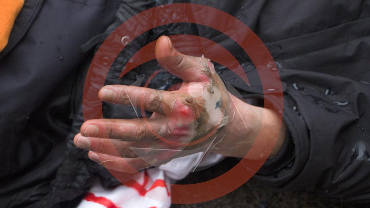 Он получил ожоги всего тела, обгоревшая одежда прилипла к коже