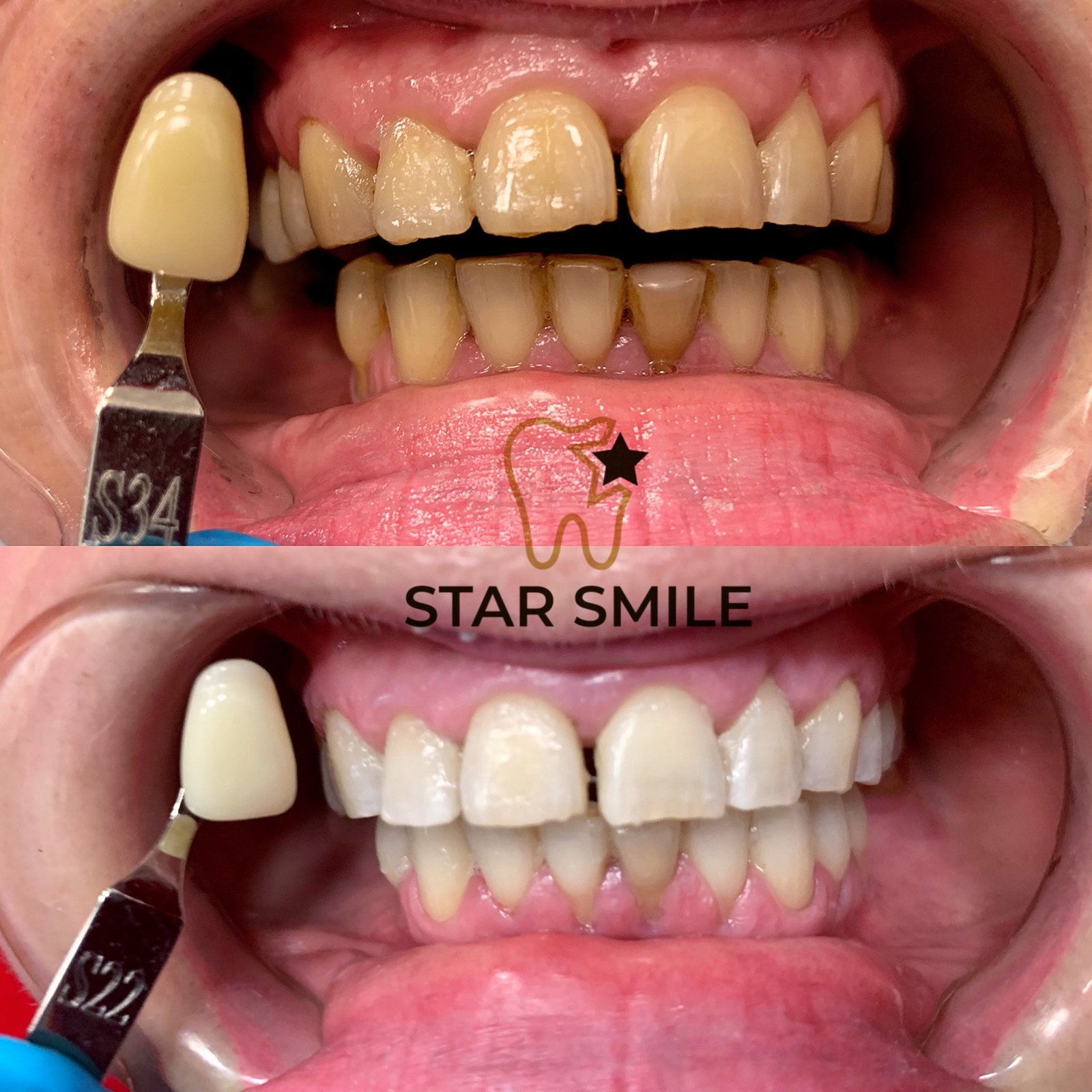 Отбеливание зубов в Киеве: где сделать и сколько стоит 1