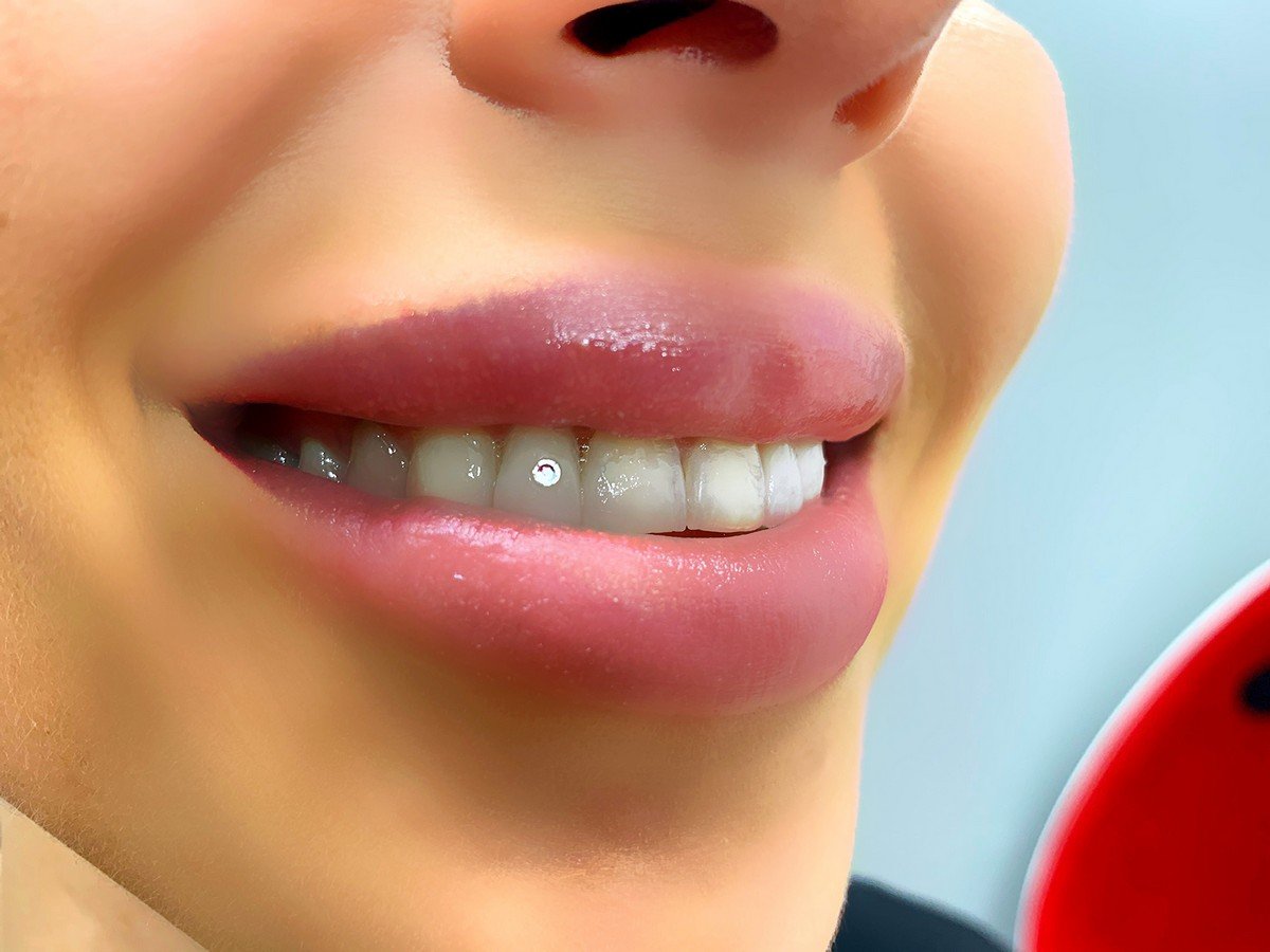 Отбеливание зубов в Киеве: где сделать и сколько стоит 3