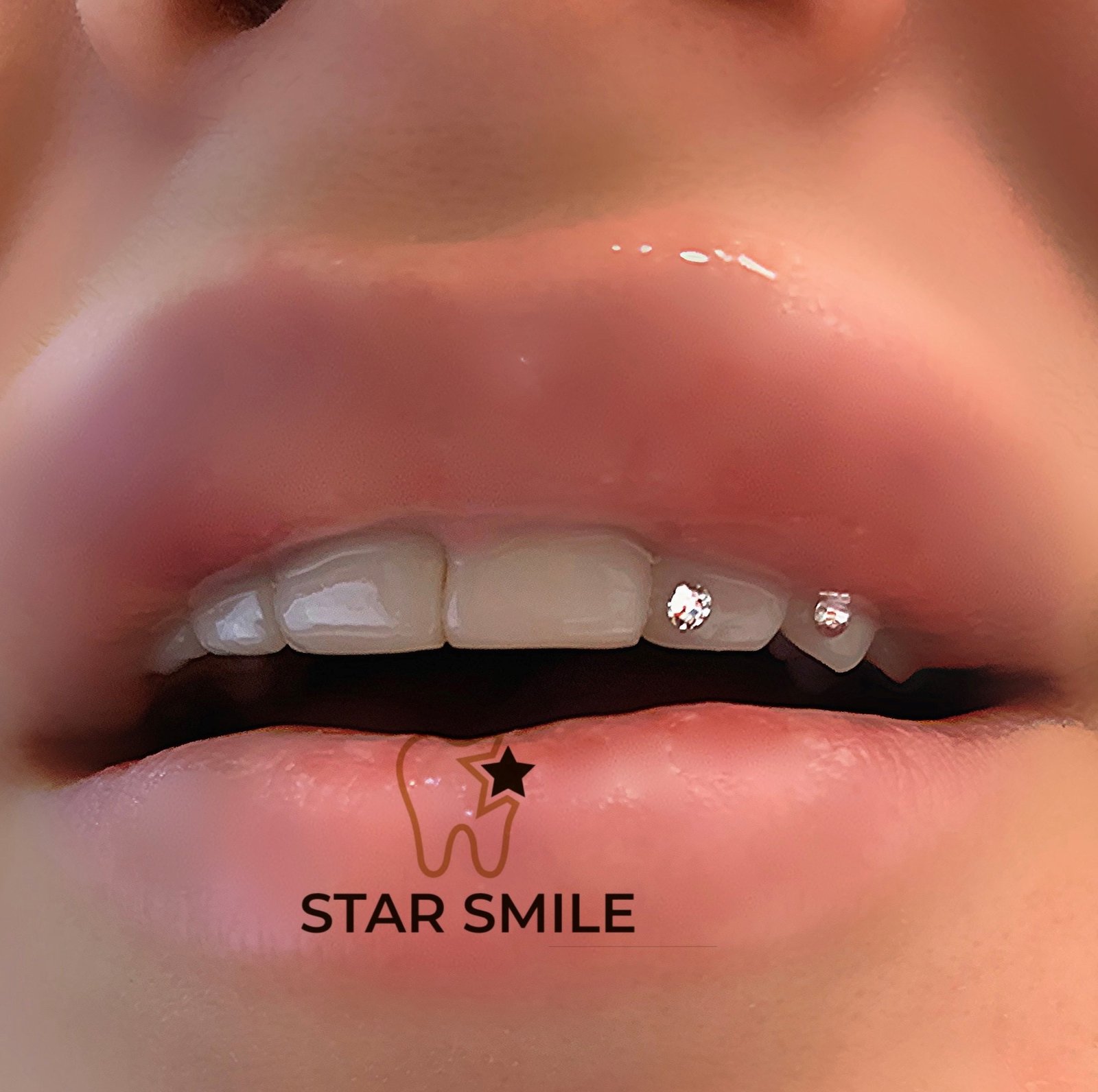 Отбеливание зубов в Киеве: где сделать и сколько стоит 4