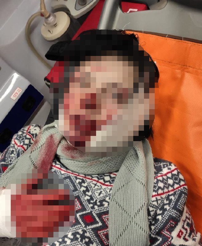 В Киеве мужчина ножом изрезал лицо сожительницы 1