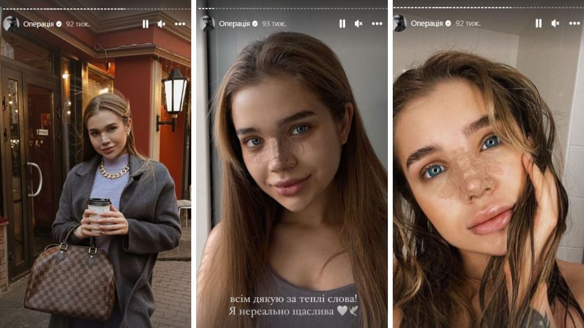 Фото - скріншоти зі збережених сторіс Саши Бо про ринопластику