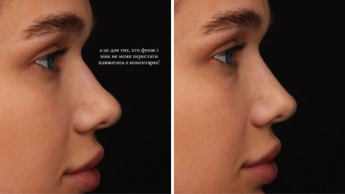 До та після. Фото - скріншот зі збережених сторіс Саши Бо про ринопластику