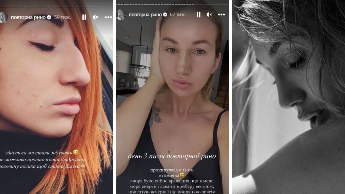 Фото: скріншот зі збережених сторіс Тані Пренткович про ринопластику