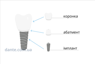 Імплантація зубів: міфи, в які не варто вірити 1