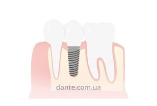 Імплантація зубів: міфи, в які не варто вірити 3