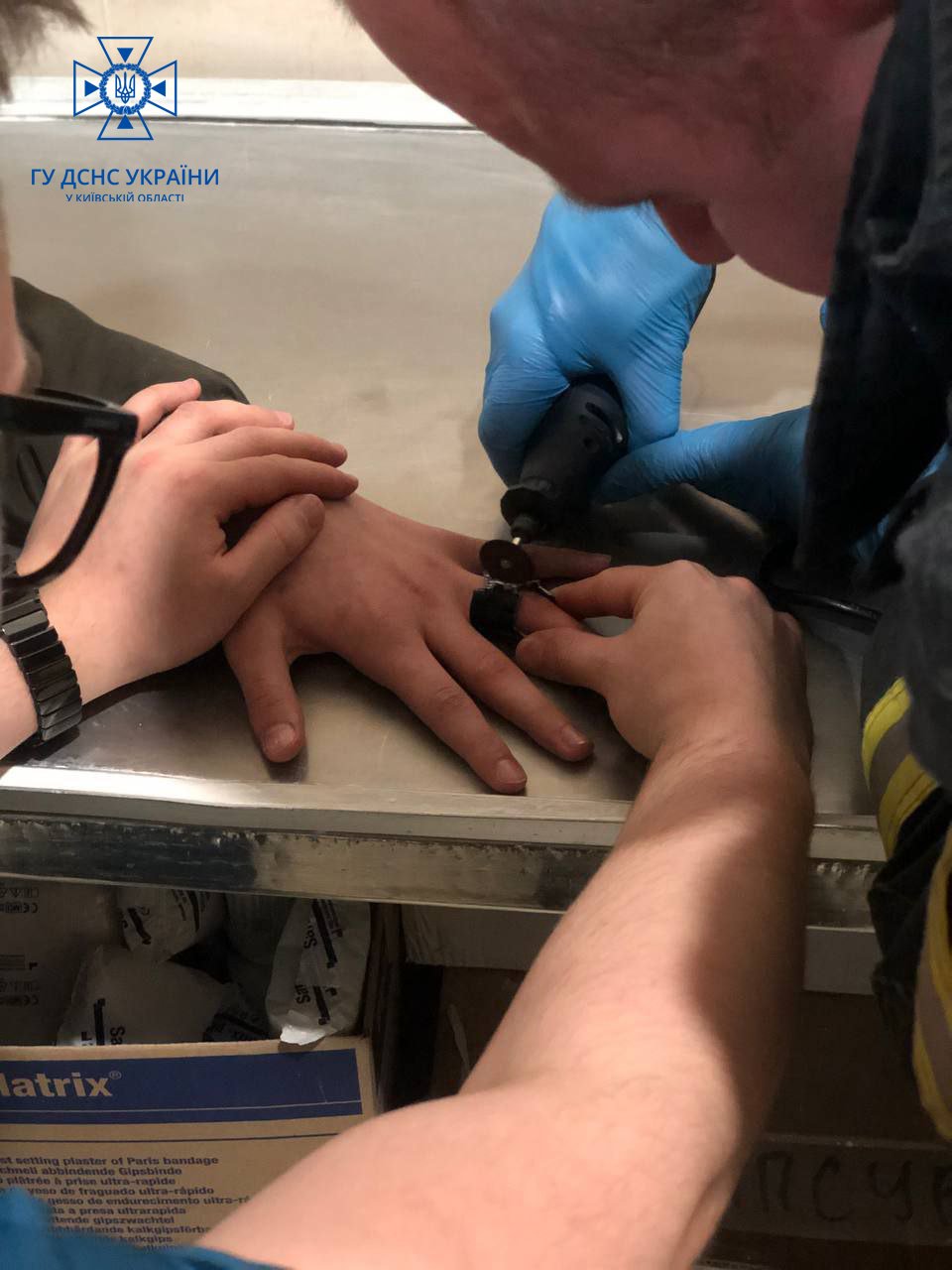 На Київщині у дитини на пальці застрягло металеве кільце від ліхтарика 2