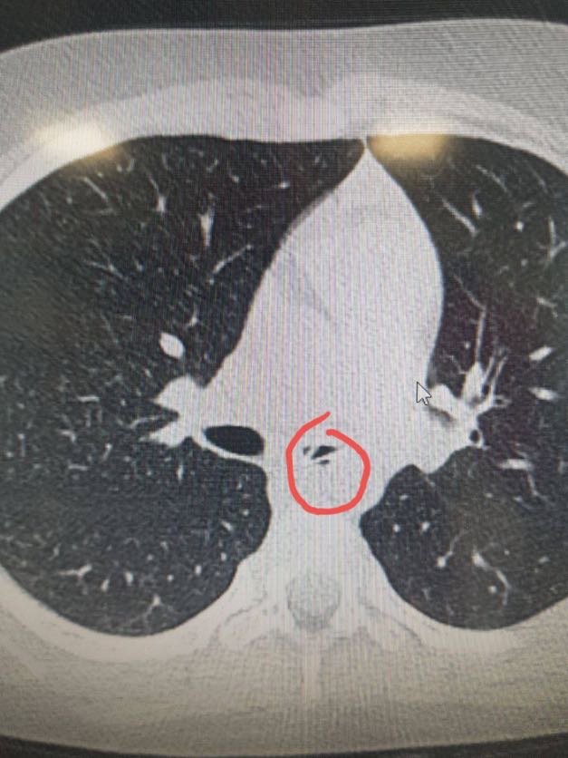 У Києві в дівчинки дістали 4-сантиметрову ложечку з дихальних шляхів 1